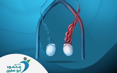 علاج دوالي الخصية