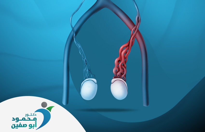 علاج دوالي الخصية