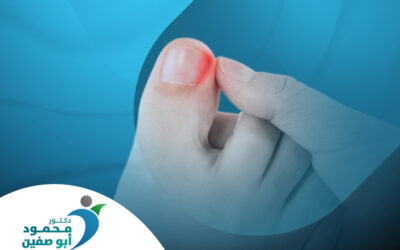 علاج الظفر الغائر