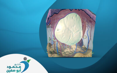 علاج الكيس الدهني و الكيس الشمعي