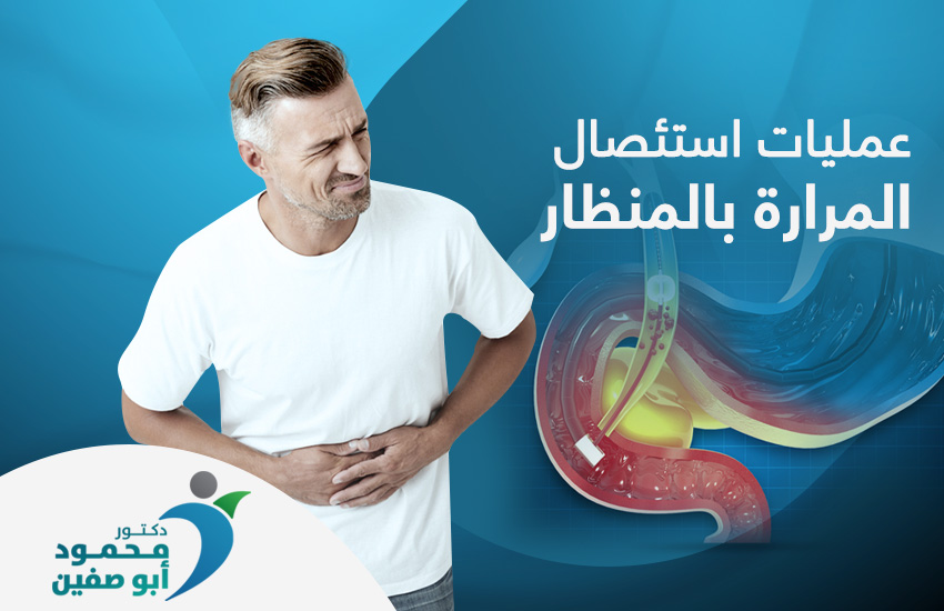 استئصال المرارة بالمنظار