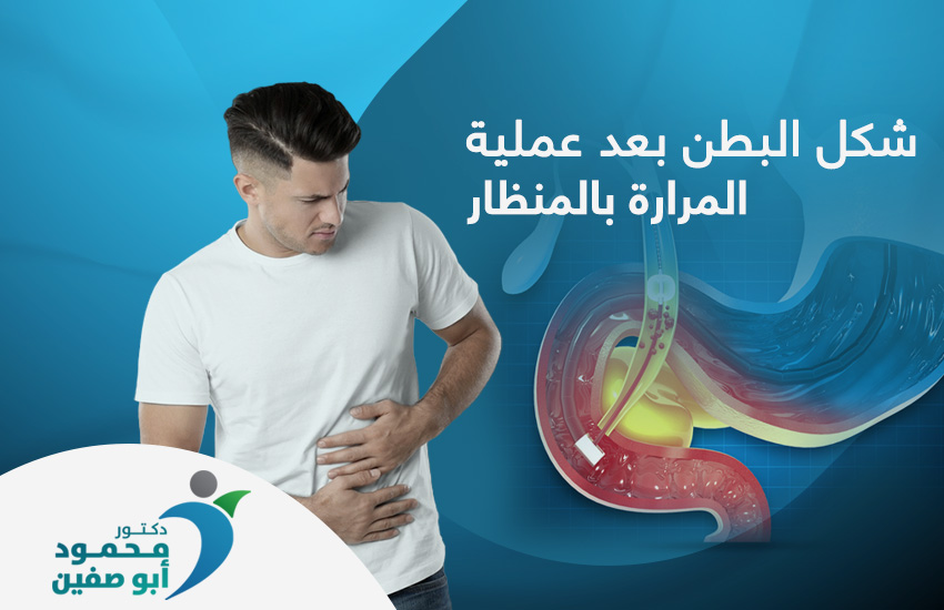 شكل البطن بعد عملية المرارة بالمنظار