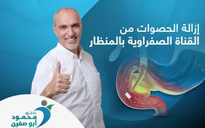 إزالة الحصوات من القناة الصفراوية بالمنظار بدون جراحة