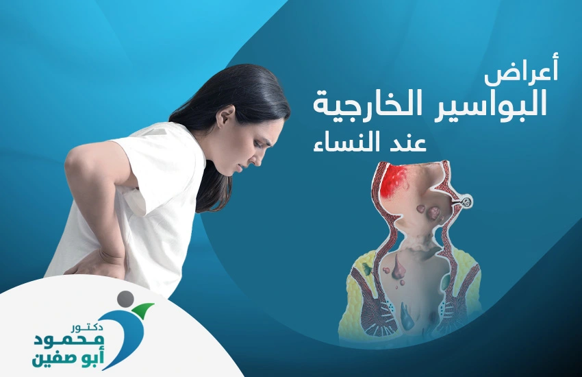اعراض البواسير الخارجية عند النساء