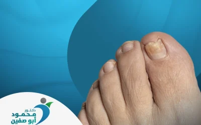 علاج فطريات الأظافر