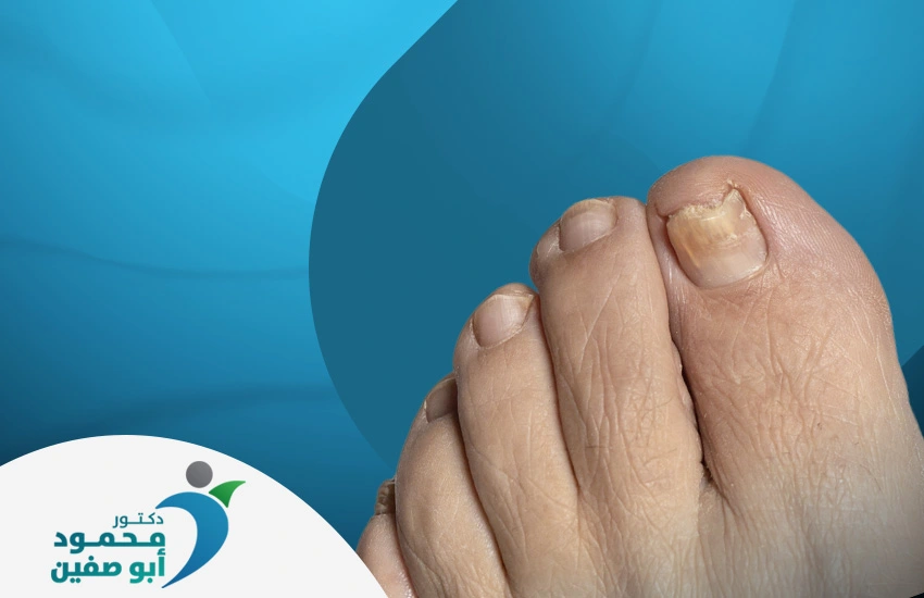 علاج فطريات الأظافر