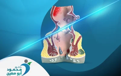 عملية البواسير بالليزر |علاج سريع وفعال بدون ألم