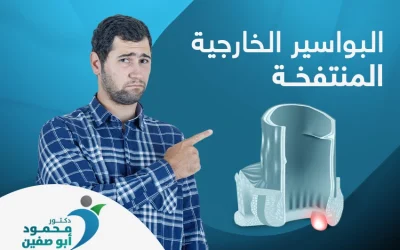 طرق علاج البواسير الخارجية المنتفخة | الجراحه ليست العلاج الوحيد