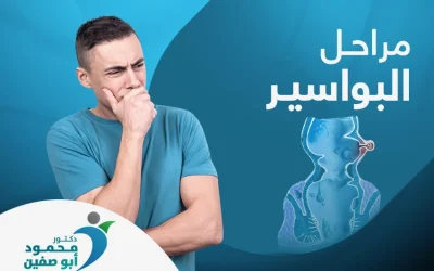 تعرف على مراحل البواسير.. أكثرها خطورة المرحلة الرابعة