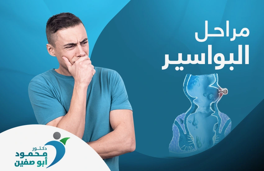 مراحل البواسير
