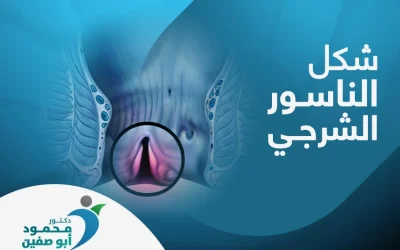 تعرف إلى شكل الناسور الشرجي وبادر بالعلاج 