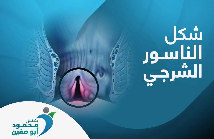 تعرف إلى شكل الناسور الشرجي وبادر بالعلاج 