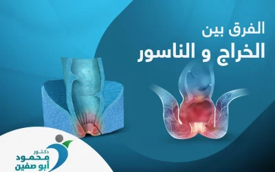 ما الفرق بين الخراج والناسور؟ وأيهما أكثر خطورة؟ 