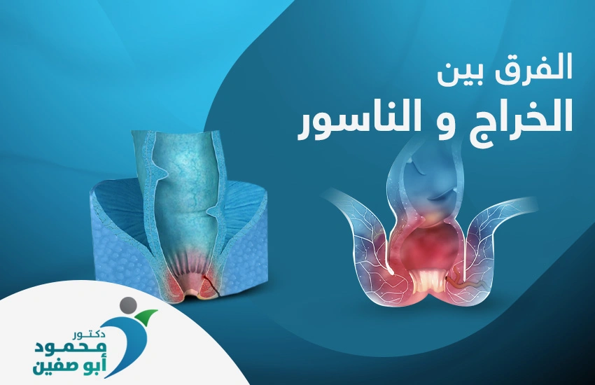 الخراج والناسور