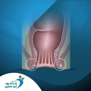 الخراج والناسور
