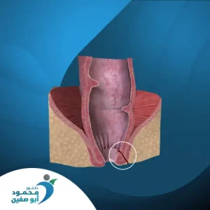 الناسور