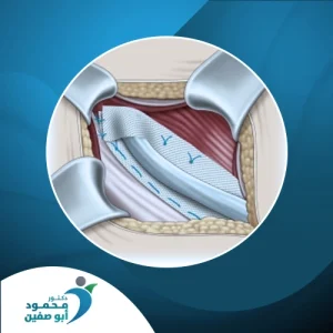 شكل شبكة الفتق2