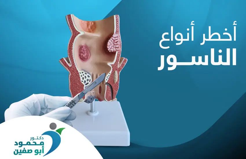 أخطر أنواع الناسور