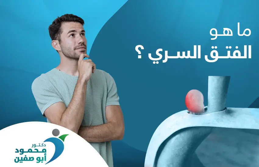 ما هو الفتق السري