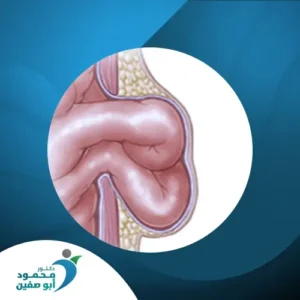 الفتق السري الكبير 