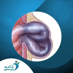 الفتق السري المختنق