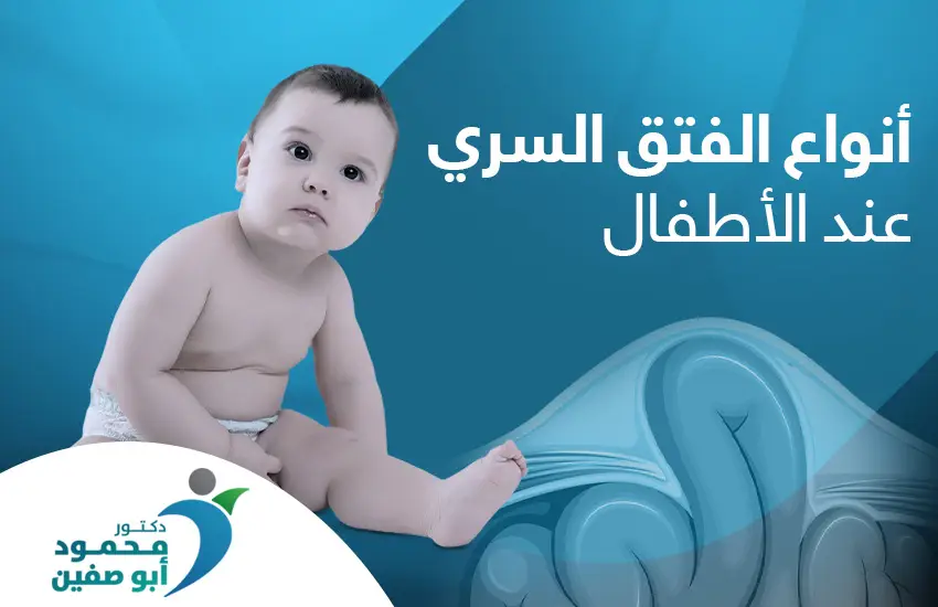 أنواع الفتق السري عند الأطفال بالصور