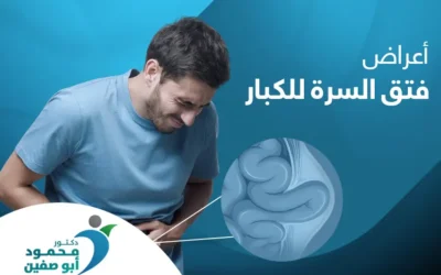 تعرف إلى أعراض فتق السرة للكبار