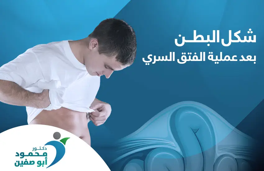 شكل البطن بعد عملية الفتق السري