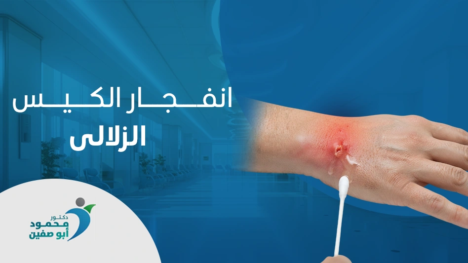 انفجار الكيس الزلالي